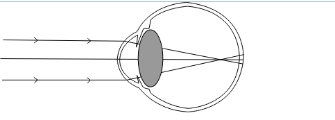 Explain with the help of a labelled ray diagram, the defect of ...