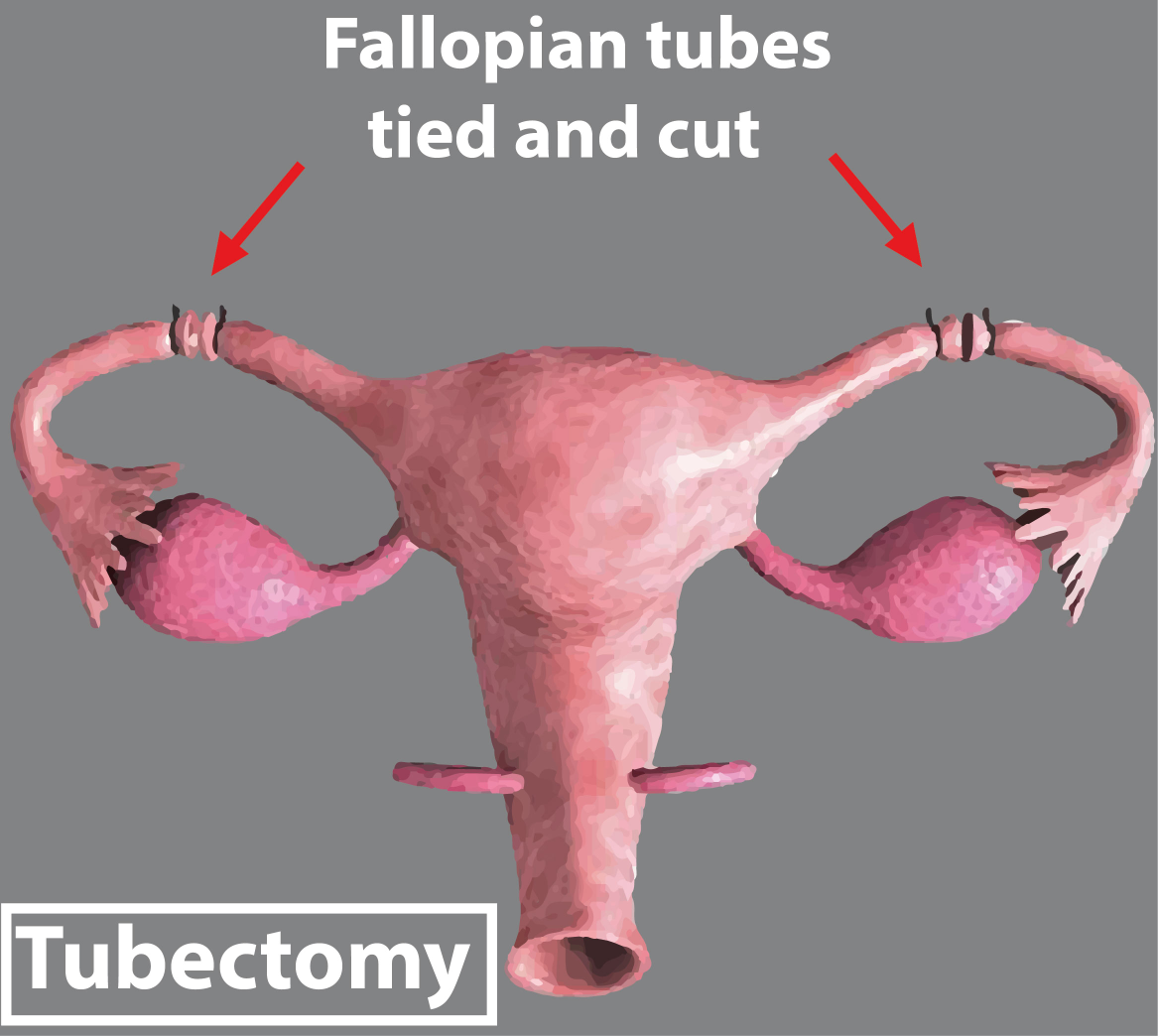 After Tubectomy Which Part Of The Female Reproductive Class 12 Biology Cbse