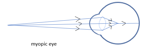 What Is Myopia And Hypermetropia How Are They Corrected Explain Using A Diagram