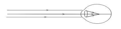 How does concave lens correct myopia?A. increases the curvature of the ...