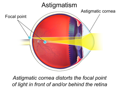 What is astigmatism ? How is it caused ? How can it be corrected?