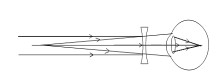 How does concave lens correct myopia?A. increases the curvature of the ...