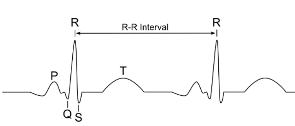 Which is not detected in ECG?A) ArrhythmiaB) Myocardial infarctionC ...