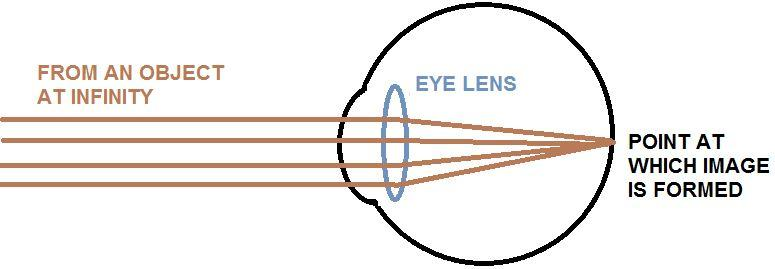 The power of a lens used to remove the myopic defect of an eye is 0.66D ...