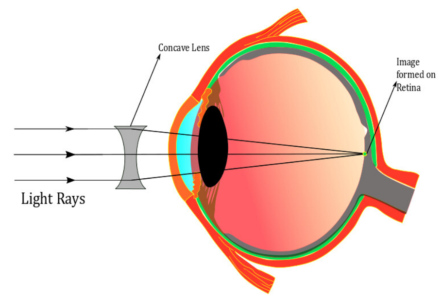 Myopia is also known as?