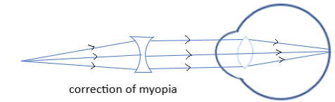 What Is Myopia And Hypermetropia How Are They Corrected Explain Using A Diagram