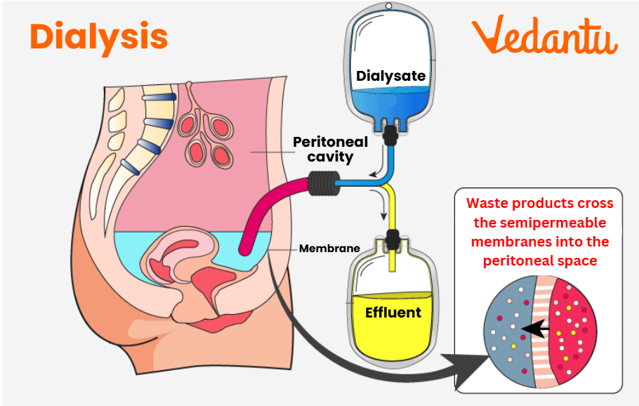 Dialysis Mechanism