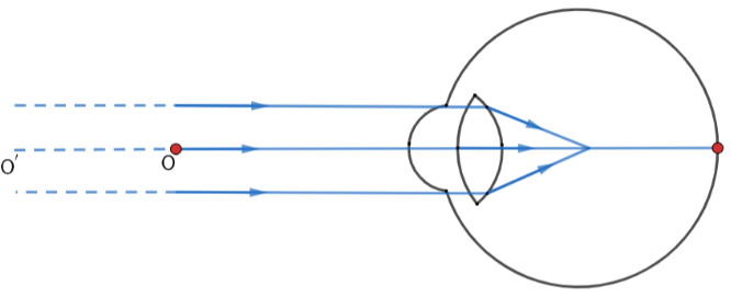 Diagram showing Myopic defect in eye