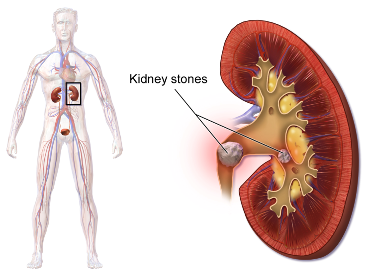 Kidney Stones