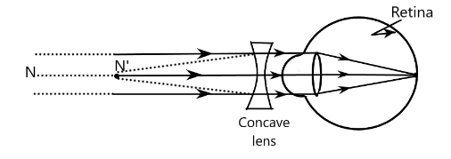 Eye with concave lens to correct myopia