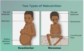 Difference Between Kwashiorkor and Marasmus